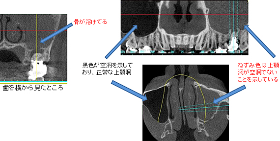 蓄膿 歯 が 痛い