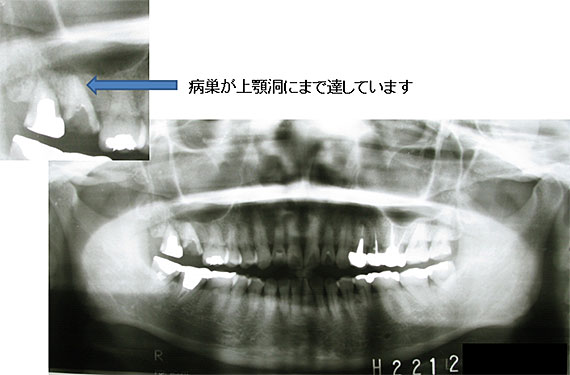 上顎洞炎の治療例２