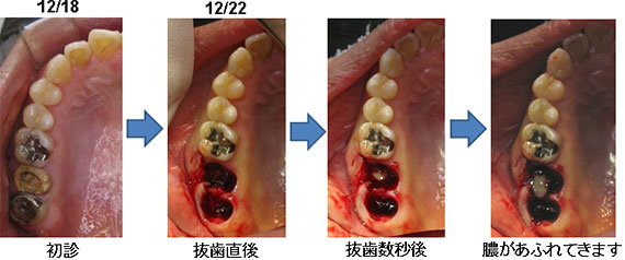 上顎洞炎の治療例２−２