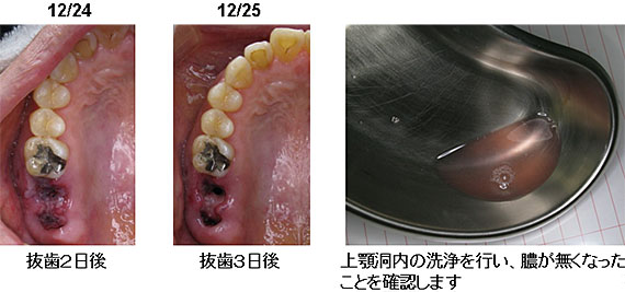 親知らず 抜歯 膿