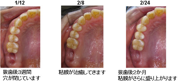 上顎洞炎の治療例２−７