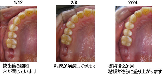 親知らず 抜い た 後 穴