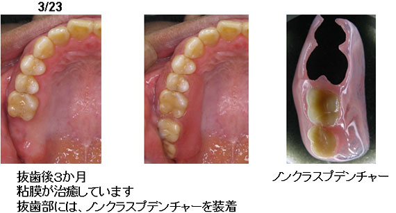 上顎洞炎の治療例２−８