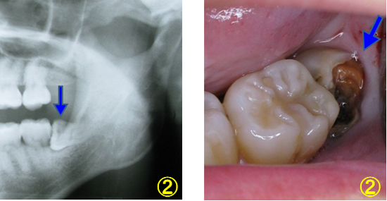 何故 親知らずを抜歯するの 又吉歯科医院