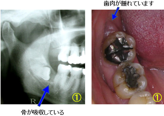 何故 親知らずを抜歯するの 又吉歯科医院