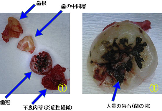 何故 親知らずを抜歯するの 又吉歯科医院