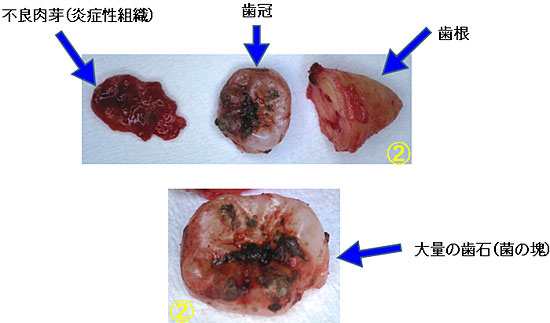 何故 親知らずを抜歯するの 又吉歯科医院