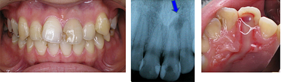 嚢胞 治療 歯根 【医師監修】歯根嚢胞（しこんのうほう）を放置すると危険な理由とは